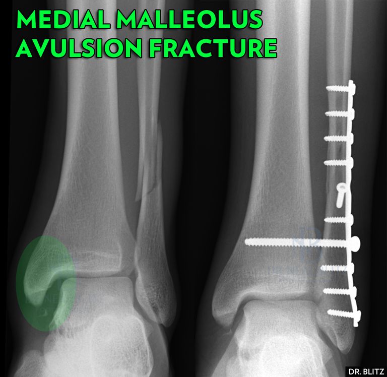 malleolære frakturer, medial malleolus, mediale malleolære frakturer, brudd ankeloperasjon, frakturer krever, frakturer krever kirurgi