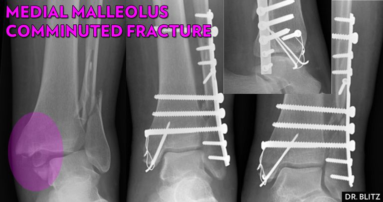 malleolære frakturer, medial malleolus, mediale malleolære frakturer, brudd ankeloperasjon, frakturer krever, frakturer krever kirurgi