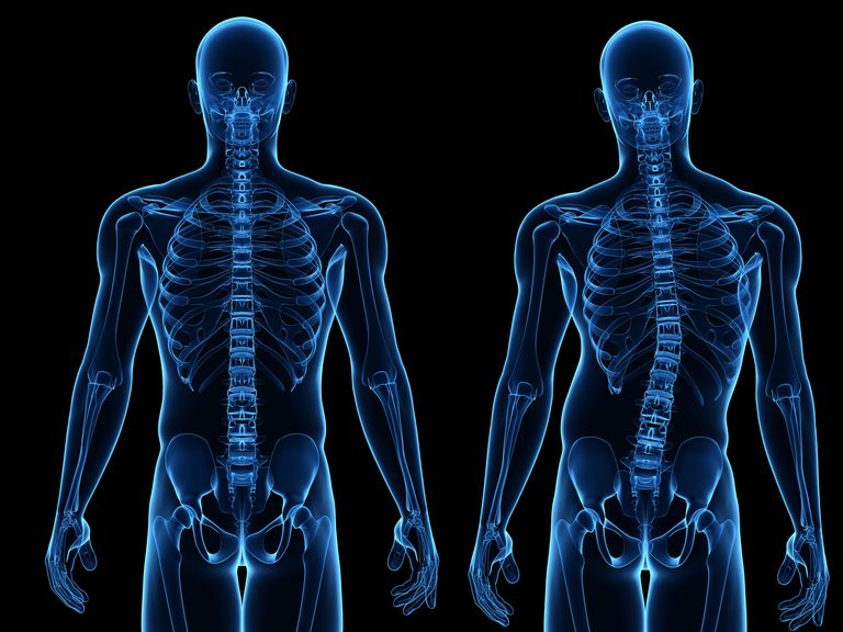 idiopatisk skoliose, Research Society, Scoliosis Research, Scoliosis Research Society, voksen idiopatisk, voksen idiopatisk skoliose