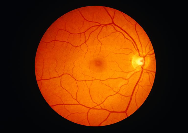 området netthinnen, optisk nerve, bakre polen, Central serøs, Central serøs retinopati