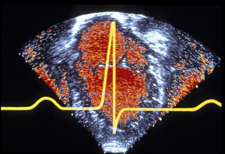 denne tilstanden, ventrikulær takykardi, høyre ventrikulær, høyre ventrikulær kardiomyopati