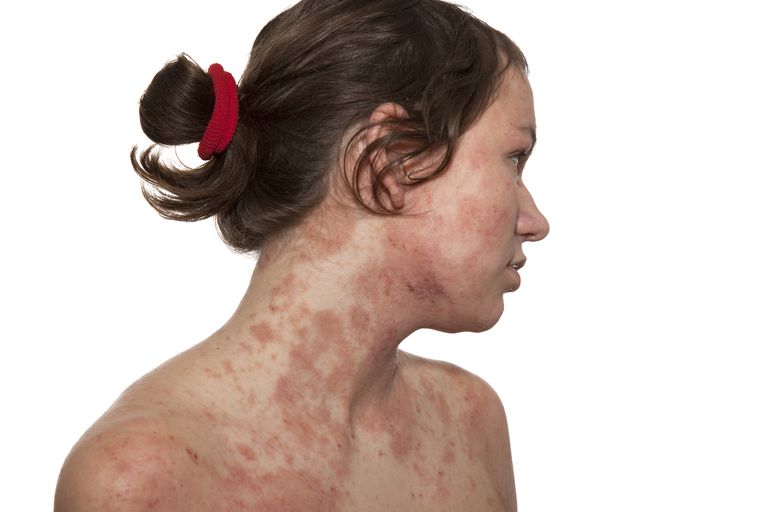 Atopisk dermatitt, allergi tester, altfor sensitiv, diagnostisere atopisk, diagnostisere atopisk dermatitt, fordi huden