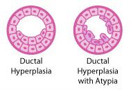 duktal hyperplasi, Atypisk duktal, utvikle brystkreft