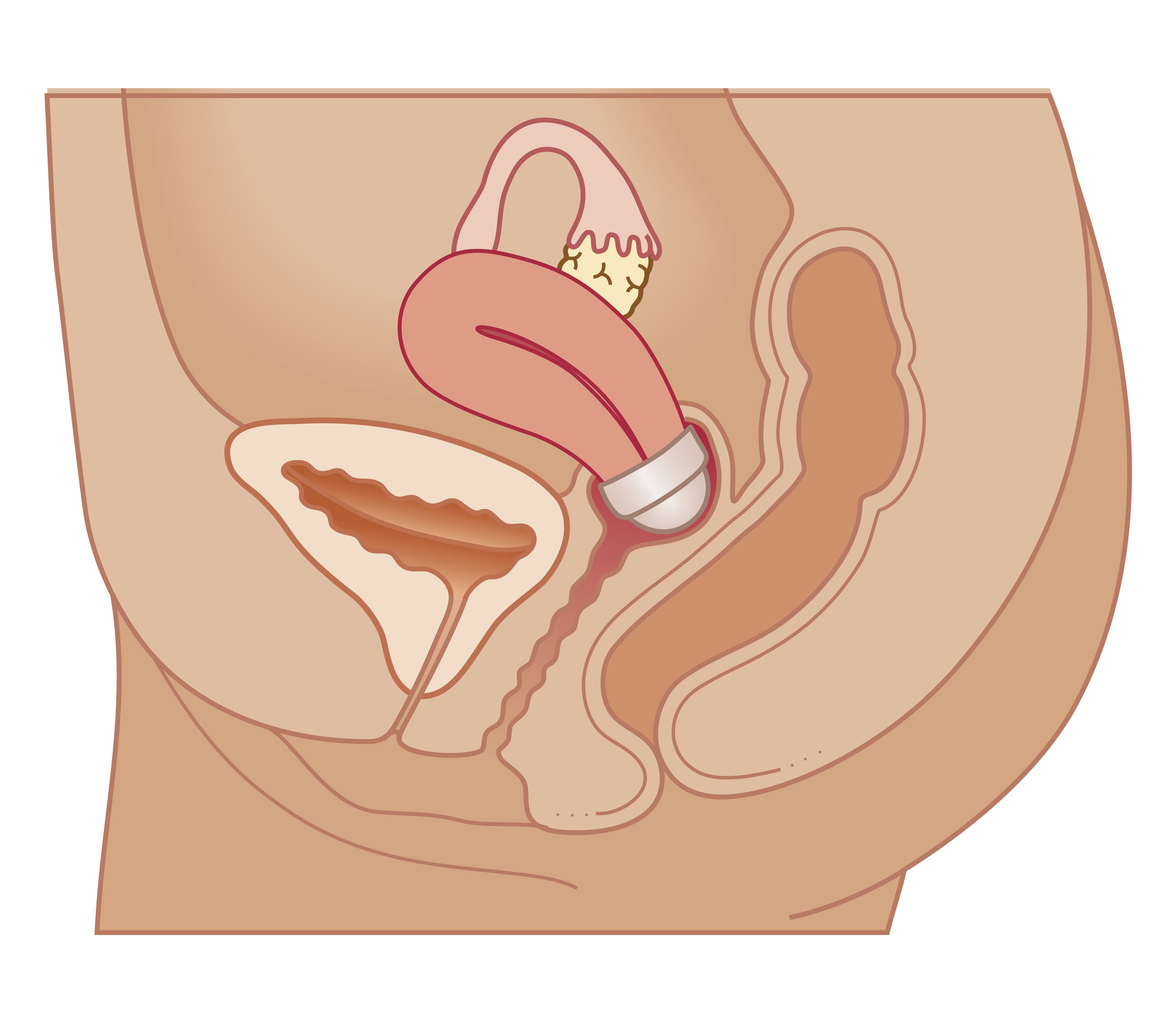 Depo Provera, Intrauterine Device, østrogen progestin, blokkerer åpningen, denne metoden