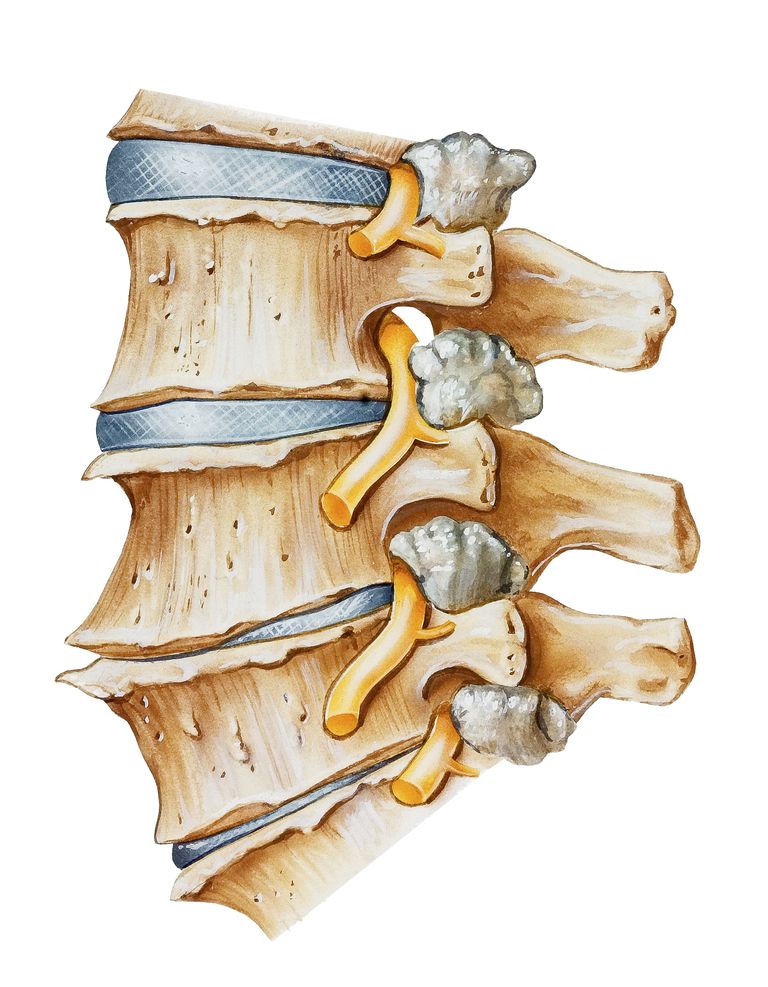spinal stenose, 2003 utgaven, 2003 utgaven Journal, Canal Stenosis