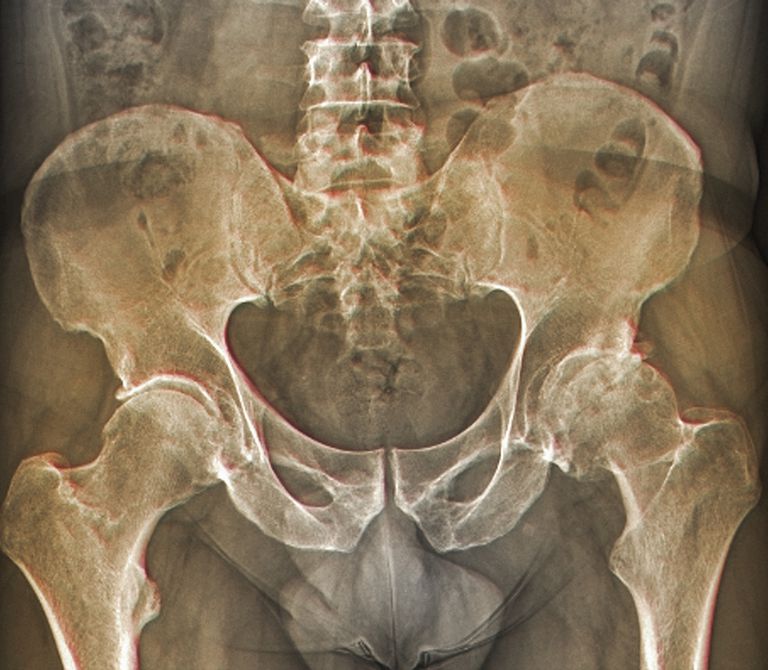endene beinet, bein bein, endene beinene, mellom endene, mellom endene beinet, Røntgenstråler vise