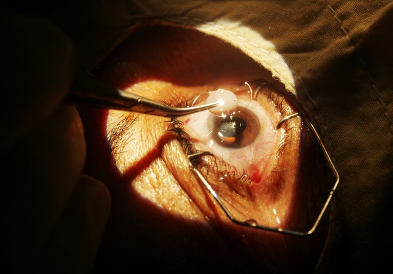 etter operasjonen, enkelte pasienter, etter kataraktoperasjon, øynene dine