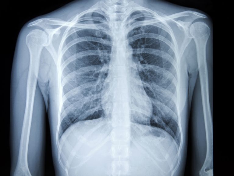 bryst røntgen, diagnose lungekreft, risikofaktorer lungekreft, Symptomer lungekreft, lungekreft ikke