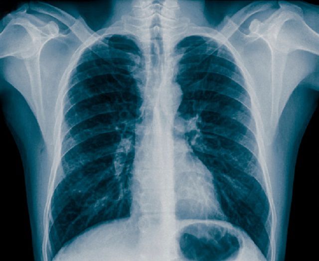 bryst røntgen, hjerte eller