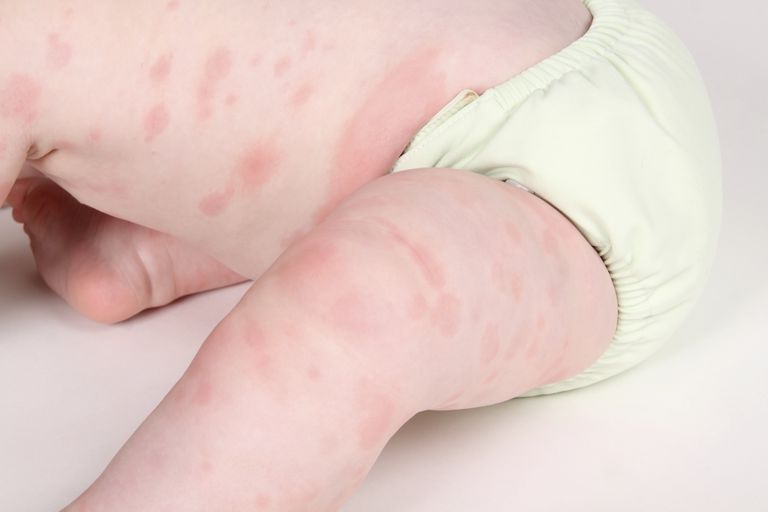 barnet ditt, allergisk reaksjon, allergisk penicillin, erytem multiforme, allergiske reaksjoner