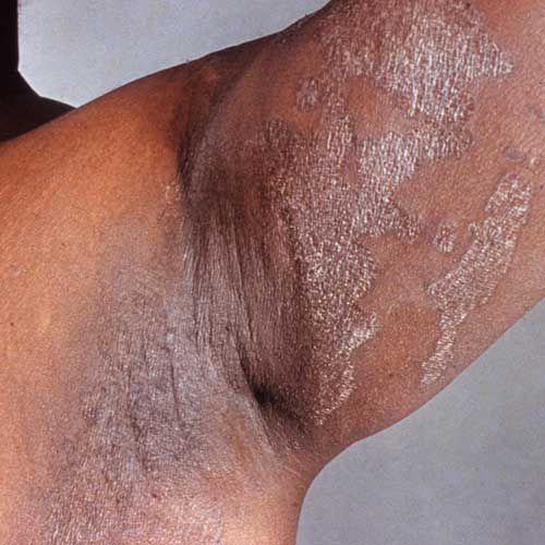 bakteriell infeksjon, Staphylococcus aureus, alvorlige infeksjoner, armhulen lysken, furuncle også, hvor huden