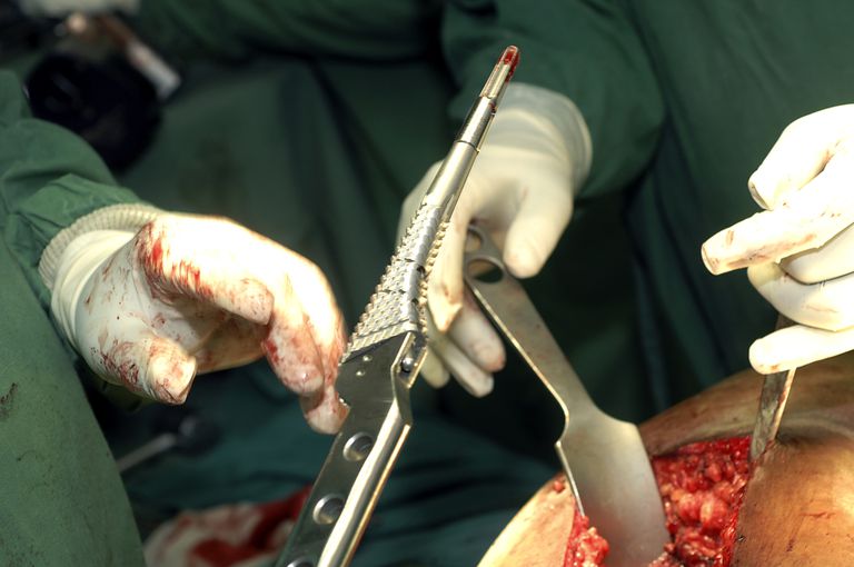 erstatning kirurgi, betennelse leddet, eller ikke, hofteskift Hip-bytteoperasjon, ikke lenger