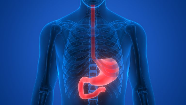 Crohns sykdom, Crohns sykdom spiserøret, øvre endoskopi, sykdom spiserøret, eller strenge, esophageal sphincter