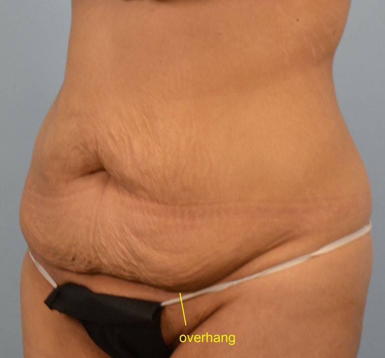 flat mage, ikke bare, opprinnelige form, overflødig fett