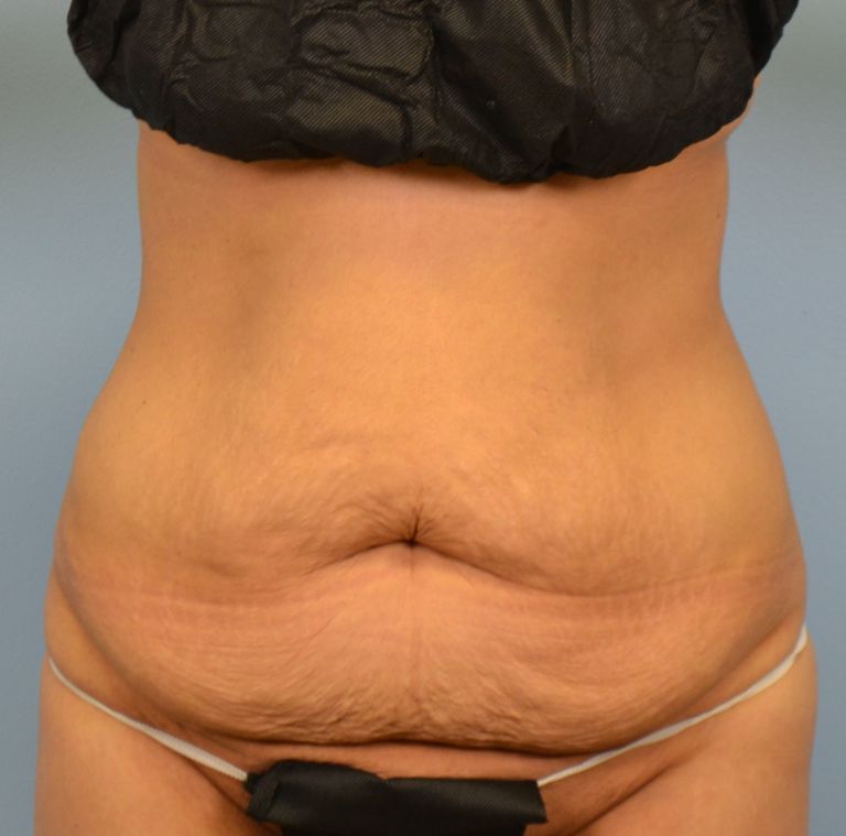 flat mage, ikke bare, opprinnelige form, overflødig fett