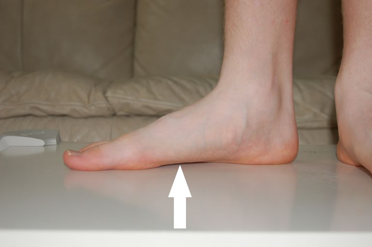 Flat føtter, flate føtter, Flat Feet, noen ganger, ofte forbundet, eller voksen