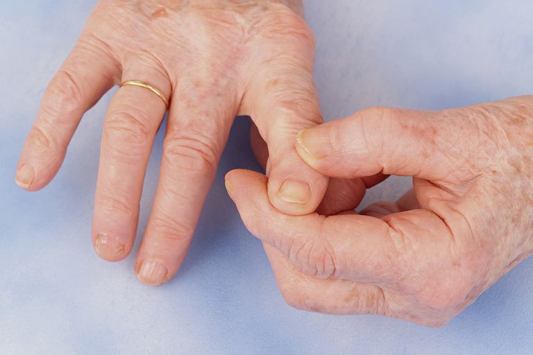 hånd artrose, anbefalinger behandling, anbefalinger basert, anbefalte betinget, behandling hånd