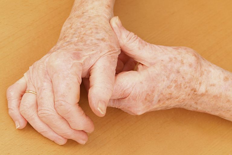 symptomene dine, diagnostisere slitasjegikt, hånd artrose