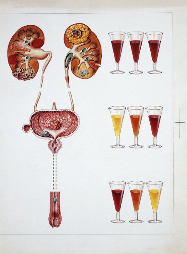 blod urinen, eller hemorroider, Hvis blod, Hvordan hematuri, leukemi lymfom