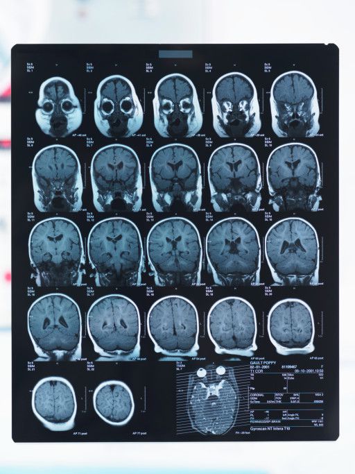 denne tilstanden, bakre leukoencefalopati, bakre leukoencefalopati syndrom, delen hjernen, endret mental