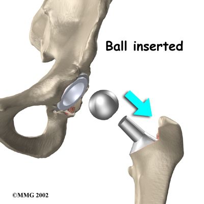 acetabulære komponenten, ballen ball-and-socket, brusk bein, glatt brusk, grov overflate, hoften gjennom