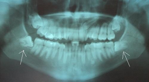 ekstra røntgenstråler, Hvis visdomstanden, kirurgiske instrumenter, nødvendig tannlegen, tannens sokkel