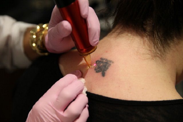 laser tattoo fjerning, laser tattoo, tattoo fjerning, tatovering fjerning