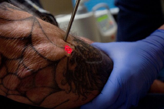 laser tattoo fjerning, laser tattoo, tattoo fjerning, tatovering fjerning