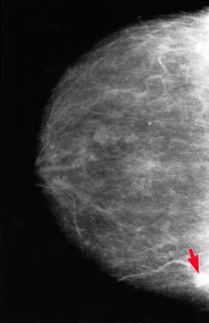 noen ganger, tett brystvev, Dette mammogrammet, Dette mammogrammet viser, disse bildene