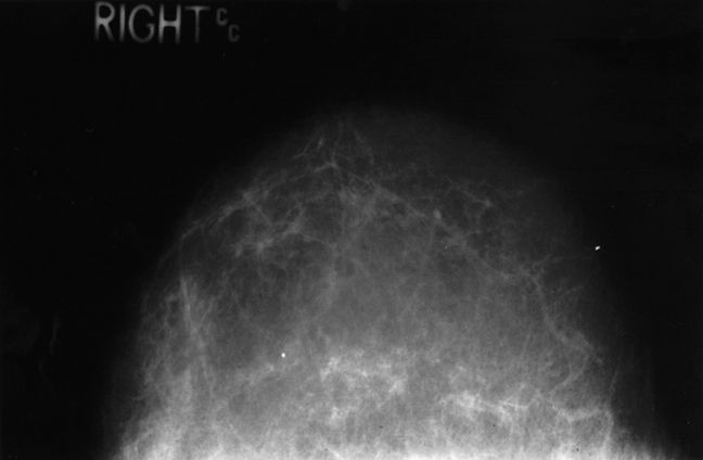 noen ganger, tett brystvev, Dette mammogrammet, Dette mammogrammet viser, disse bildene