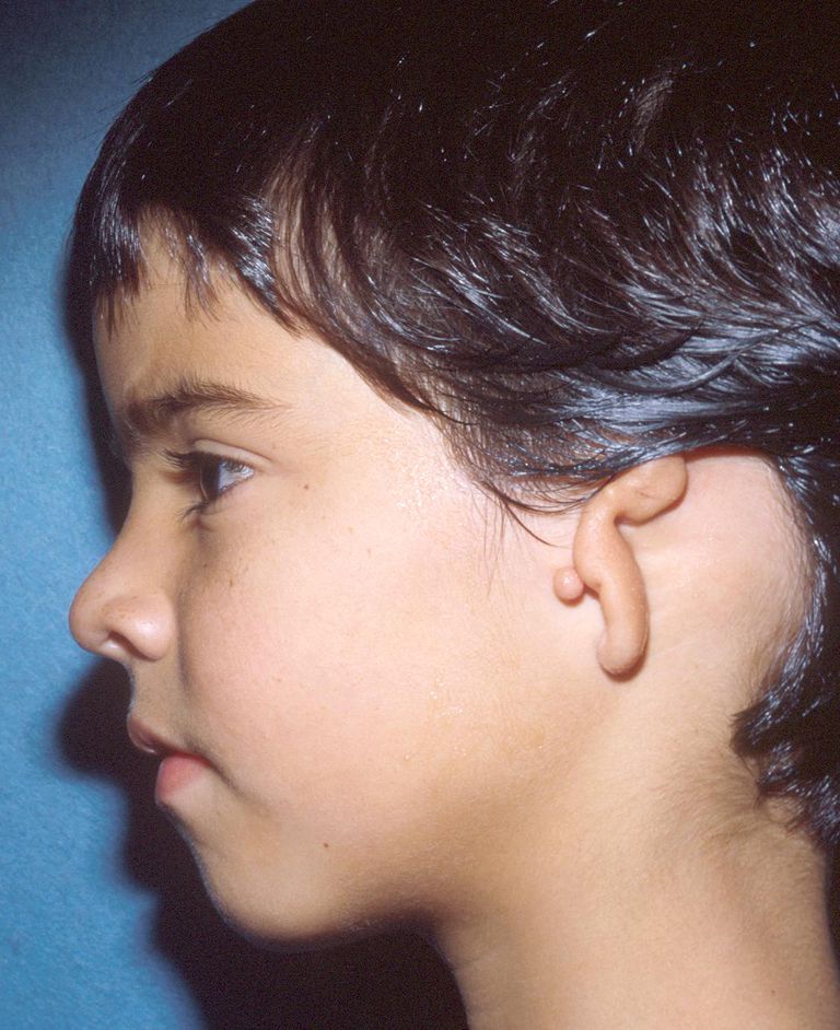 barn mikrotia, indre øret, denne tilstanden, ytre øret, benforankret høreapparat
