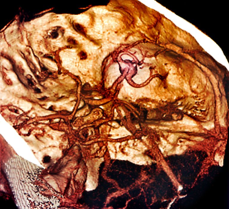 cerebrale arterien, midtre cerebrale, midtre cerebrale arterien, cerebral arterieslag, cortex styrer