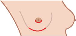 naturlige brystvorter, brystvannsbesparende mastektomi, dine naturlige, dine naturlige brystvorter, brystet eller, brystvorten forsinkelse