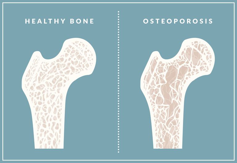 andre behandlingsalternativer, behandling osteoporose, forebygging behandling, forebygging behandling osteoporose