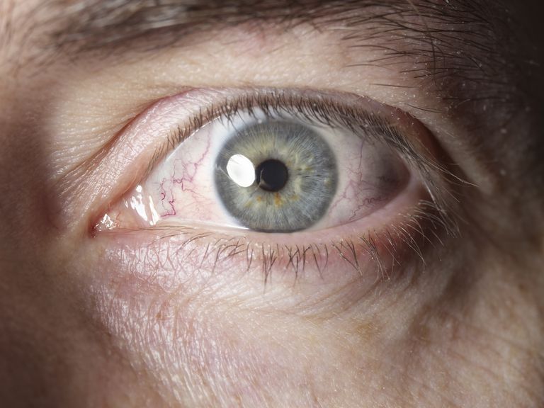 pharyngoconjunctival feber, dette tilfellet, føle bedre, innsiden øyelokkene, også kjent, vasokonstrictor antihistamin