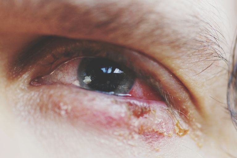 Abdominal smerte, allergisk konjunktivitt, anafylaktisk reaksjon, etter spist, hovne øyne