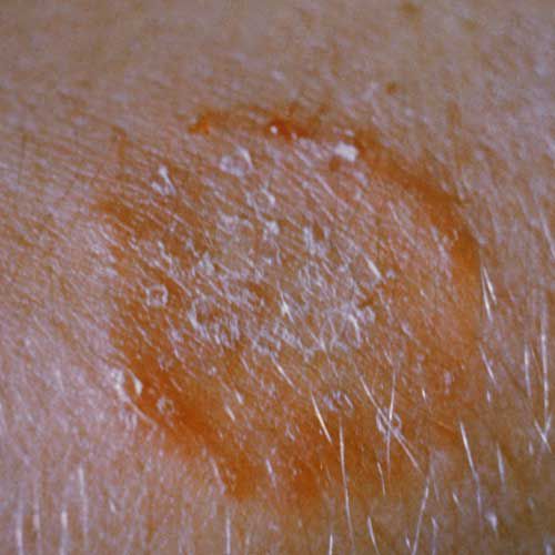 mellom fingrene, Dette eksempel, eller tinea, forårsaket herpes