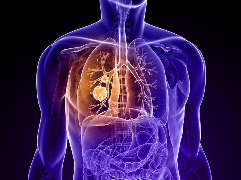 årsaker lungemasse, Hvis legen, sannsynlig være, aktiv vekst, aldri røykt, årsaker lungemasser