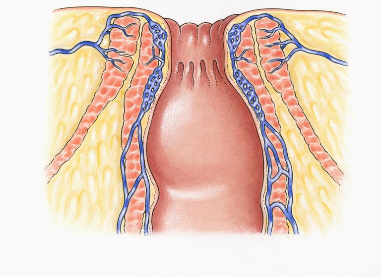 Crohns sykdom, ulcerøs kolitt, denne operasjonen, dette området, Etter proctectomy, kolorektal kirurg