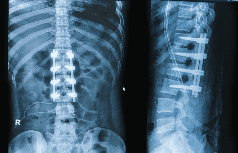 spinal fusion, AAOS sier, Behandling pseudoartrose, eller ledninger, etter spinal