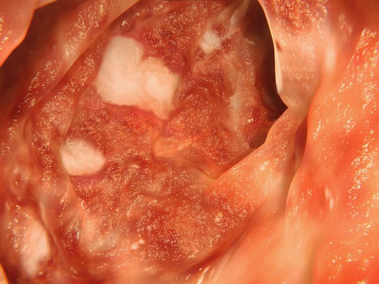 ulcerøs kolitt, Crohns sykdom, eller avføringen, være behov