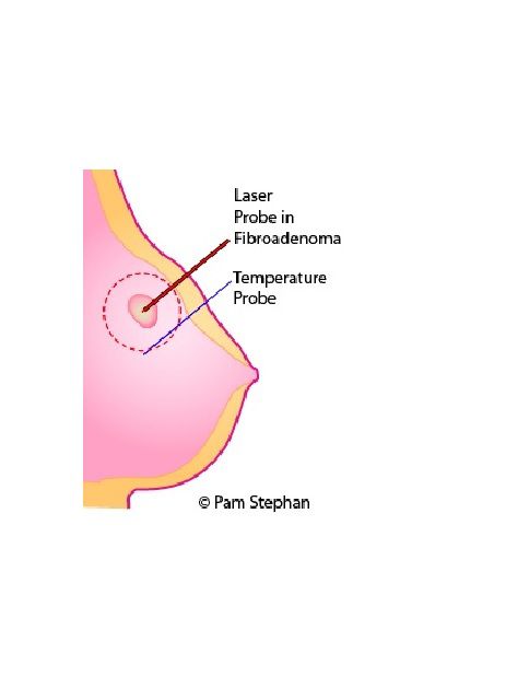 godartede brysttumorer, bare lite, generell anestesi, laserablation godartede, laserablation godartede brysttumorer, perspektiv laserablation