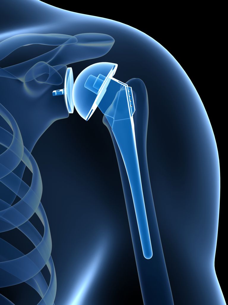 rotator mansjett, Shoulder Hemiarthroplasty, komplett skulderutskifting, skulder artritt