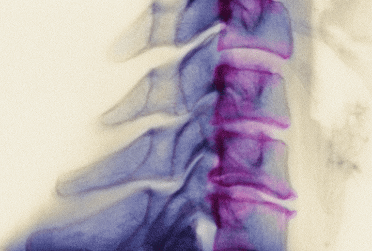 august 2006, spinal muskelatrofi, Denne artikkelen, Hentet august, motor neuron, muskelatrofi Hentet august