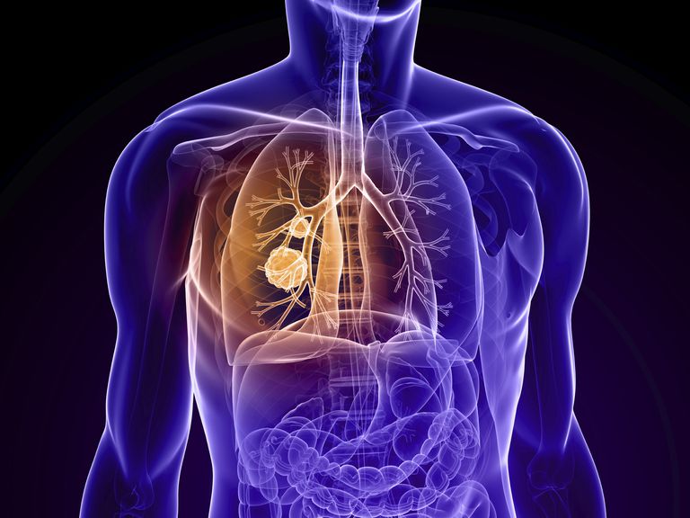 stadium lungekreft, ikke-småcellet lungekreft, primær lungekreft, andre primære, andre primære kreftformer