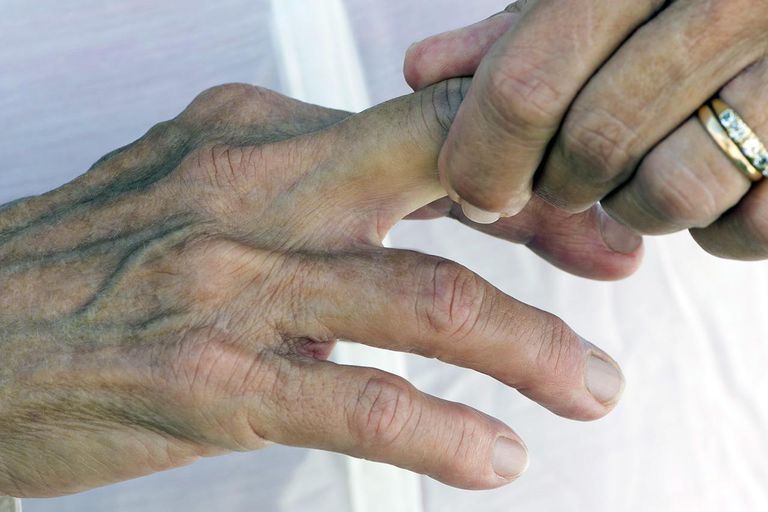 brudd eller, eller forstyrrelse, fastkjørt finger, brudd eller forstyrrelse, eller osteopat