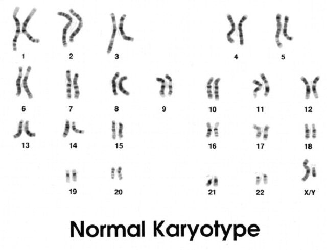 Downs syndrom, genetisk problem, ifølge National, karyotype avslører