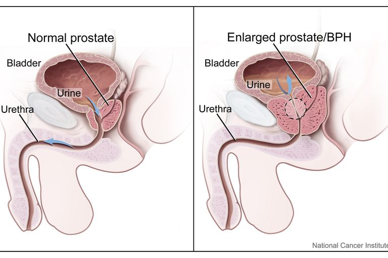 prostata kreft, blir eldre, eldre menn, erektil dysfunksjon, forårsake mange