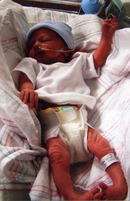 Dette bilde, nyfødt baby, baby klubbfot, begge føttene, bilateral klubbfot, bilde spedbarn