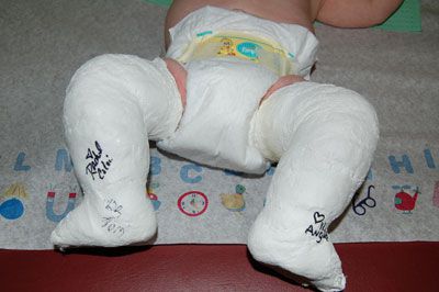 Dette bilde, nyfødt baby, baby klubbfot, begge føttene, bilateral klubbfot, bilde spedbarn
